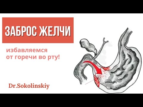 Заброс желчи в желудок: как избежать неприятностей с рефлюксом и ГЭРБ?