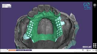 exocad partial design upper( A-P bar)