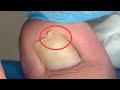 Double layer toenail repair