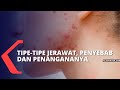 Rahasia Jerawat: Penyebab Tersembunyi dari Riasan Wajahmu