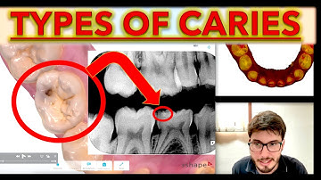 DENTAL CARIES for Beginners! Clinical Vs Bitewings (ICDAS classification, cavity teeth class, IOS)