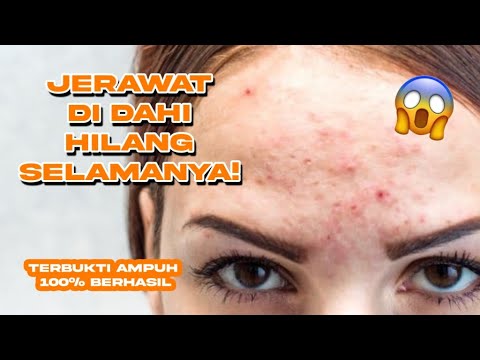 CARA MENGHILANGKAN JERAWAT DI DAHI DENGAN CEPAT DALAM SEMALAM! - YouTube