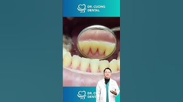 Cuối năm rồi, đi lấy cao răng thôi |Dr Cường Offical