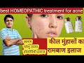Say Goodbye to Pimples |Clear & Glowing Skin Secrets.By Dr.Nitish Sharma(13yrs Exp)pimple free Skin.