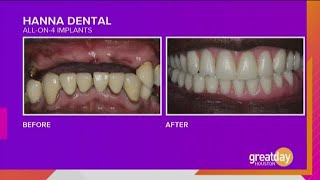 Dr. Raouf Hanna showcases another Hanna Dental Implant Center success story