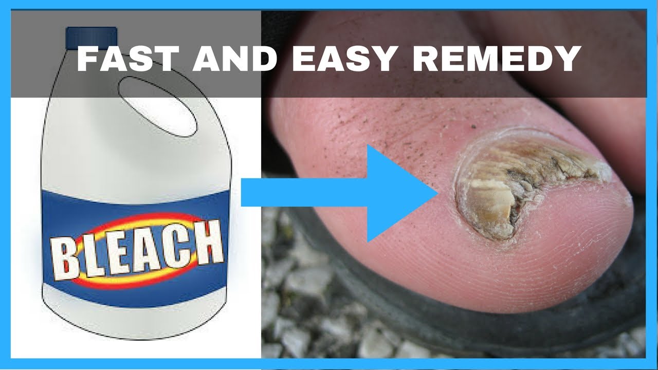 How to Get Rid of Toenail Fungus with Bleach - Toe Fungus Journey ...