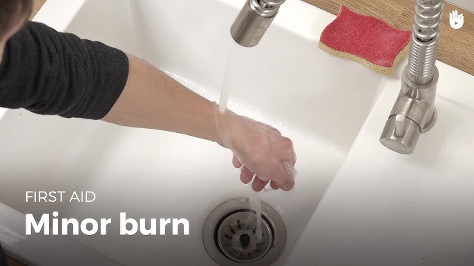 Hot Pan Burned My Hand — Treatment Tips - Mayo Clinic News Network
