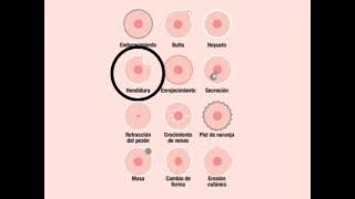 Signos de Cáncer de Mamas