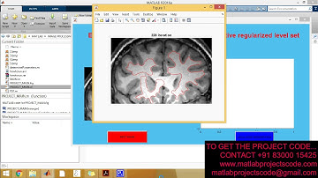 Weighted level set evolution based on local edge features for medical image segmentation