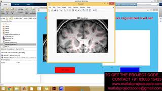 Weighted level set evolution based on local edge features for medical image segmentation