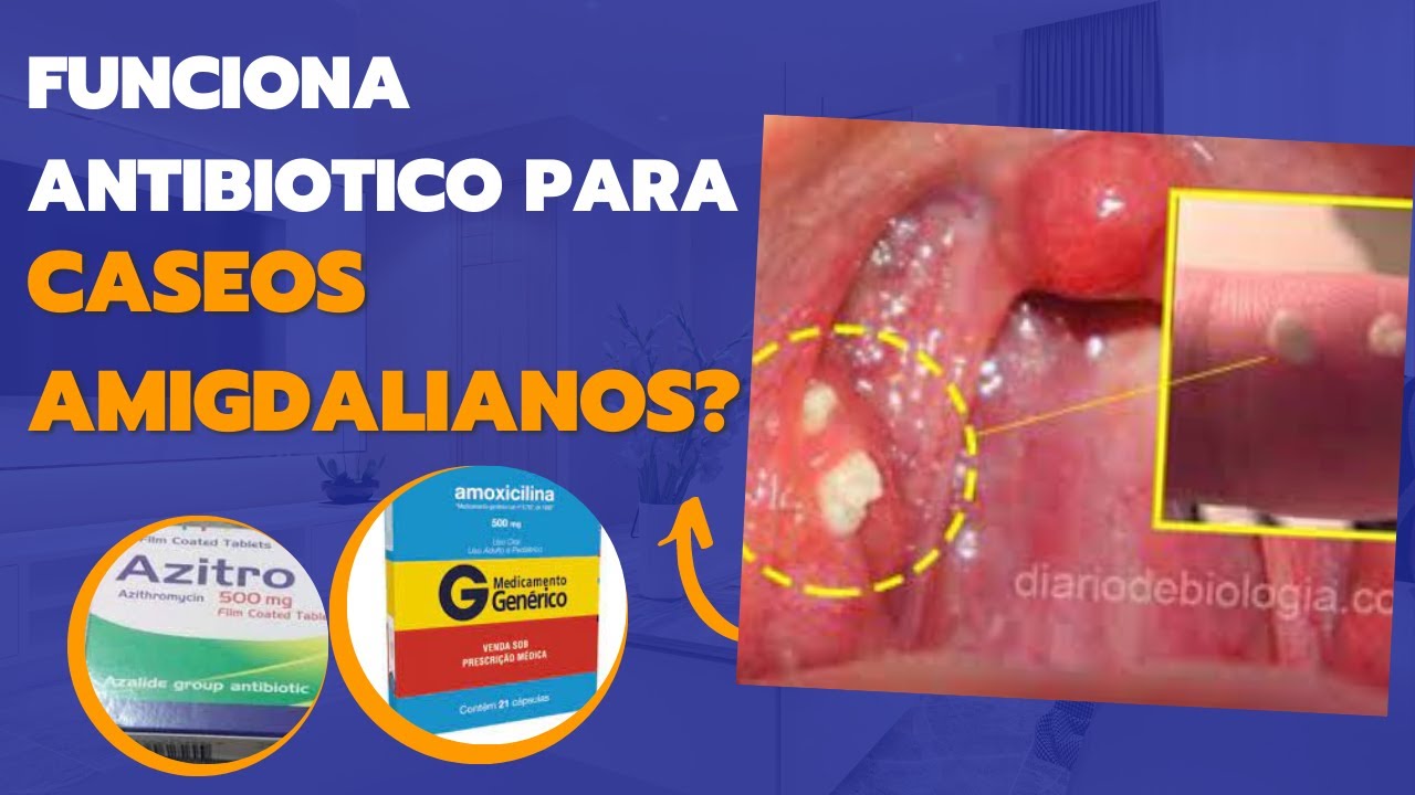 Antibiótico para caseo nas amigdalas (bolinhas fedidas na garganta)?, image size:1280x720