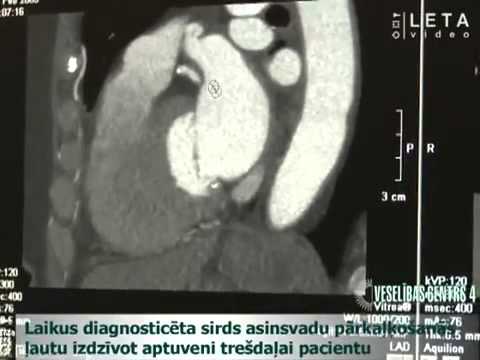 Video: Sirds (aortas) Vārstuļa Sašaurināšanās Kaķiem