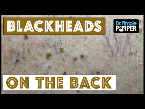 Back Blackhead Extractions After Mohs Surgery