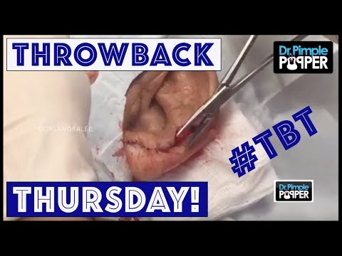 Reminiscing With Dr. Pimple Popper - TBT Part 11