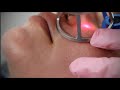 Rohrer Aesthetics' Phoenix CO2 Laser System Overview