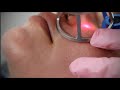 Rohrer aesthetics phoenix co2 laser system overview