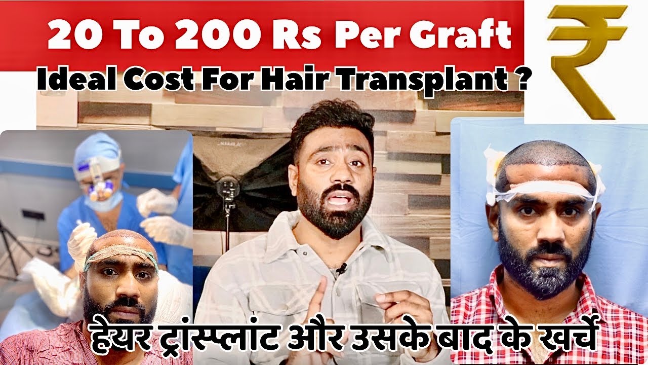 💰Cost of Hair Transplant in India Hair Transplant Mai kitna Kharcha