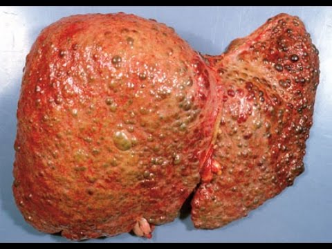 Liver Cirrhosis | Segment 1 | Health 1st | Dr. Sanjeev - Neejavan - YouTube