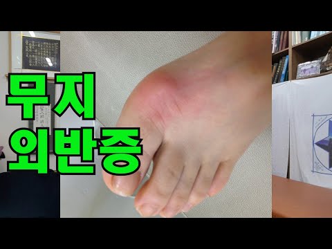 무지외반증- 여성분들에게 다발되는 질환입니다.