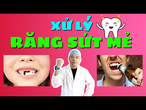 Răng Sứt Mẻ