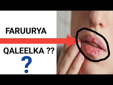 🔴 FARUURYA  QALEELKA (  chapped lips ) ? IYO  SHAN -- SHEEY OO SABABTO ??  IYO SIDA LOO DAAWEEYO ??