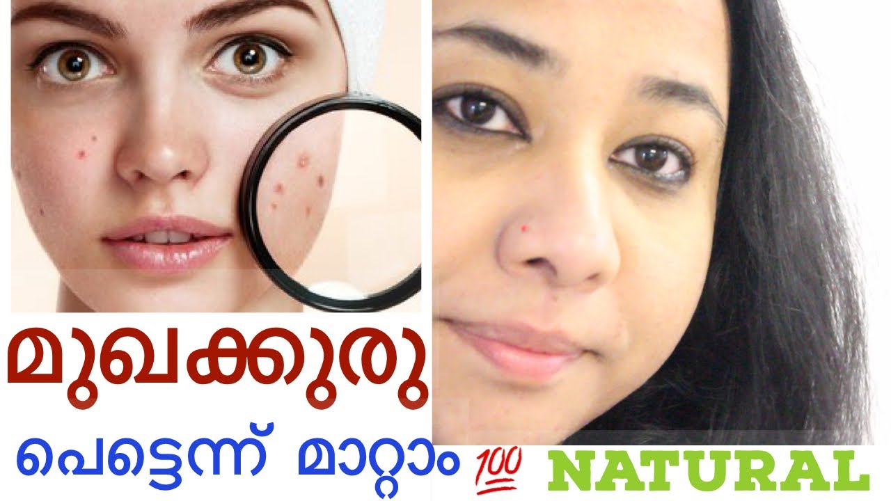 മുഖക്കുരു പെട്ടെന്ന് മാറാൻ വീട്ടുമുറ്റത്തെ ഒരു ആയുർവേദ രഹസ്യക്കൂട്ടു Pimple treatment malayalam