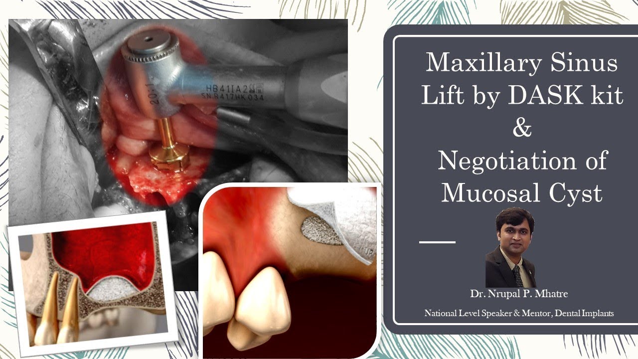 Maxillary lateral sinus lift with DASK kit ( Dentium ) and Management