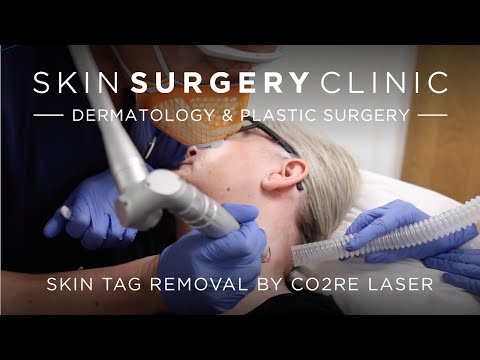 How to removal skin tag with laser machine?