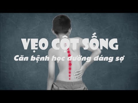 Video Cong vẹo cột sống ở trẻ lứa tuổi học đường: Nhận biết... - YouTube