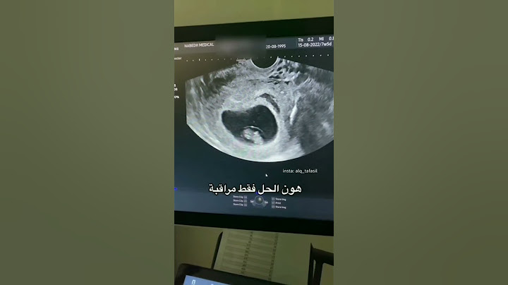النزيف في بداية الحمل