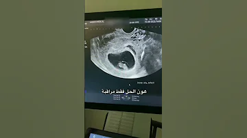 النزيف في بداية الحمل 