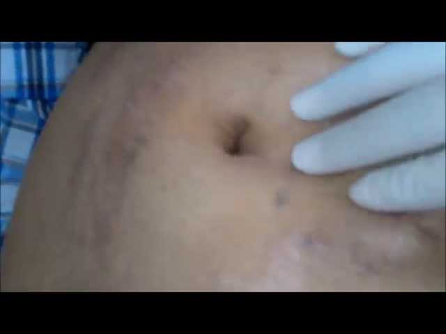 Caput Med Paraumbilical Vein Caput Medusae