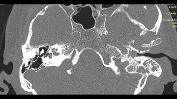 How to Read HRCT Temporal Bone : All Basics in Detail