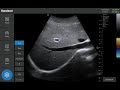 Healson handheld convex ultrasound abdomen