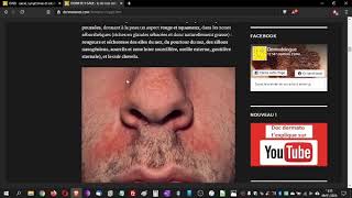Ce Que Personne Ne Dit Sur La Dermite Séborrhéique