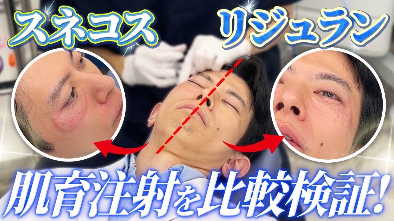 【半顔検証】“リジュラン” vs “スネコス” 人気の肌育注射はどっちが効果があるの？【アンチエイジング / 美肌】