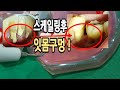 잇몸 구멍 생기는  스케일링 과정   / 강창용  치과의사