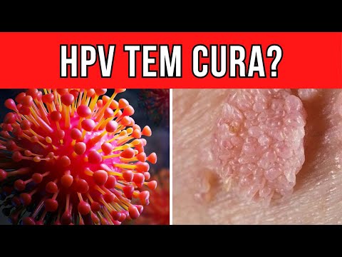 Existe Cura ou Tratamento Para o Vírus HPV?