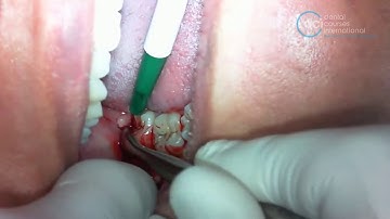 Surgical extraction of a distoangular impacted third molar