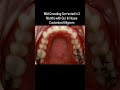 Aligners used to have buzz, now patients have questions. Trays used to feel like the only option, no