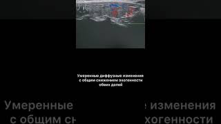 #узи #щитовиднаяжелеза  #аит