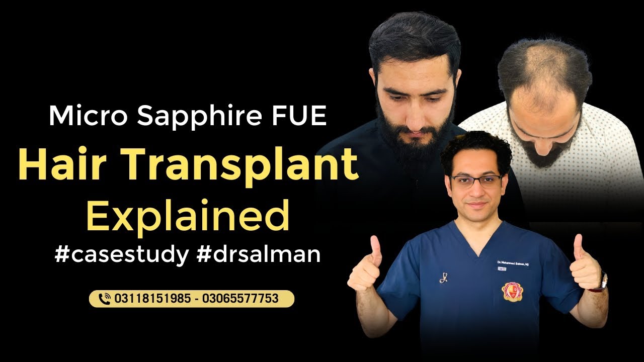Type 5 Baldness Hair Transplant: Early Intervention & Confidence Boost | Dr Salman Plastic Surgery