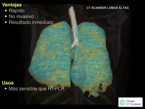 Tomografía Computada de Tórax, detección Covid-19