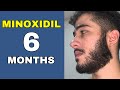 Minoxidil beard journey 6 months transformation