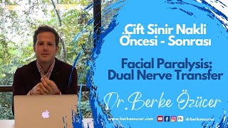 Facial Paralysis Treatment Beforeafter Dual Nerve Transfer