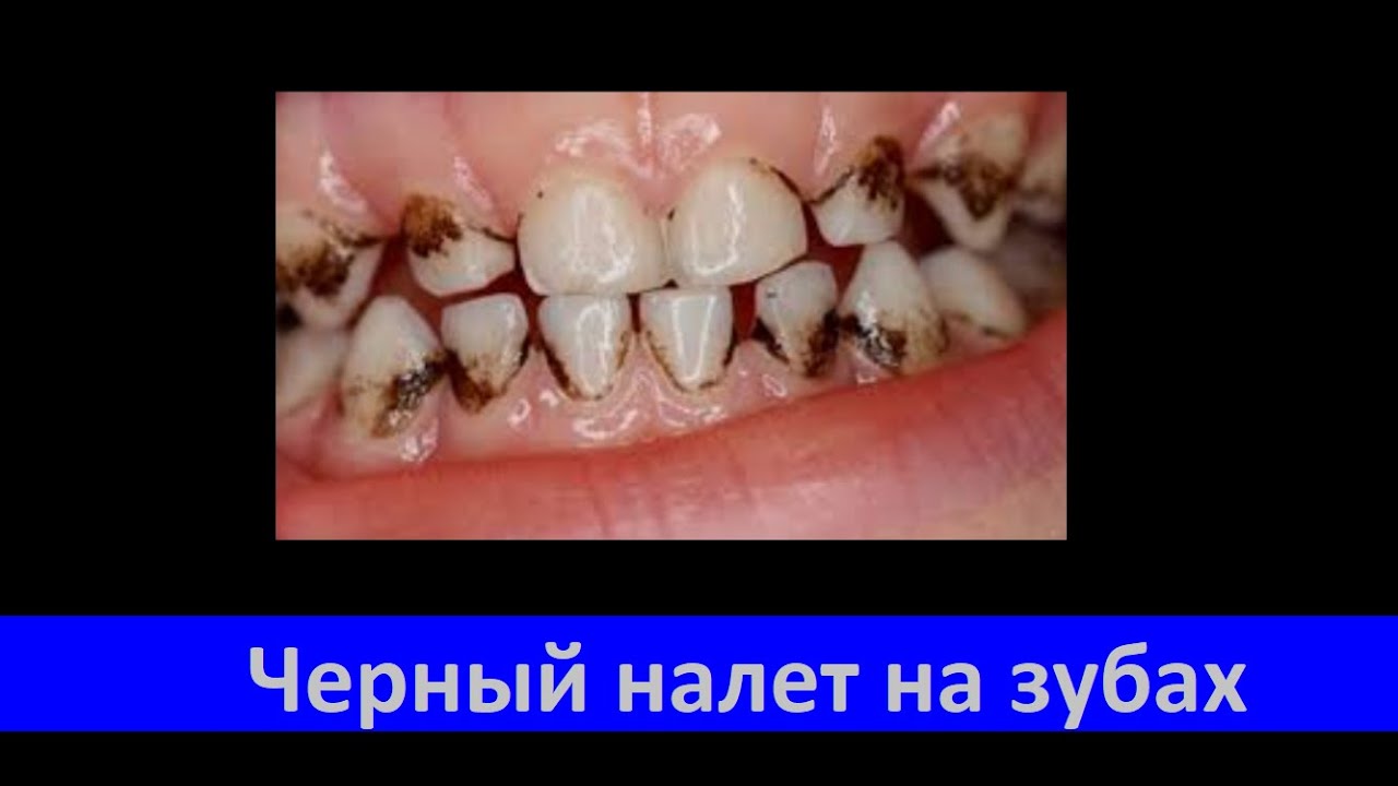 Черный налет на зубах № 214