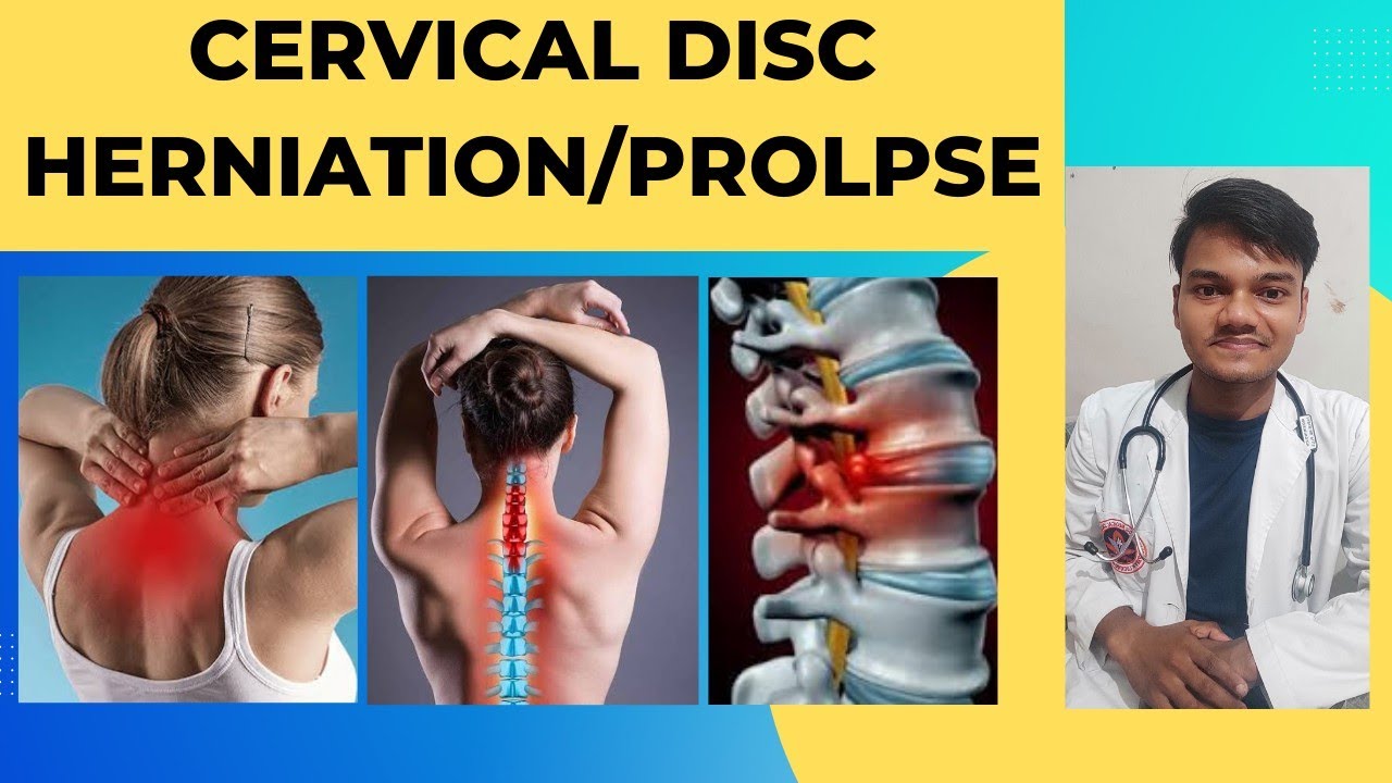 Cervical Disc Herniation / Disc Prolapse Treatment in Ayurveda YouTube