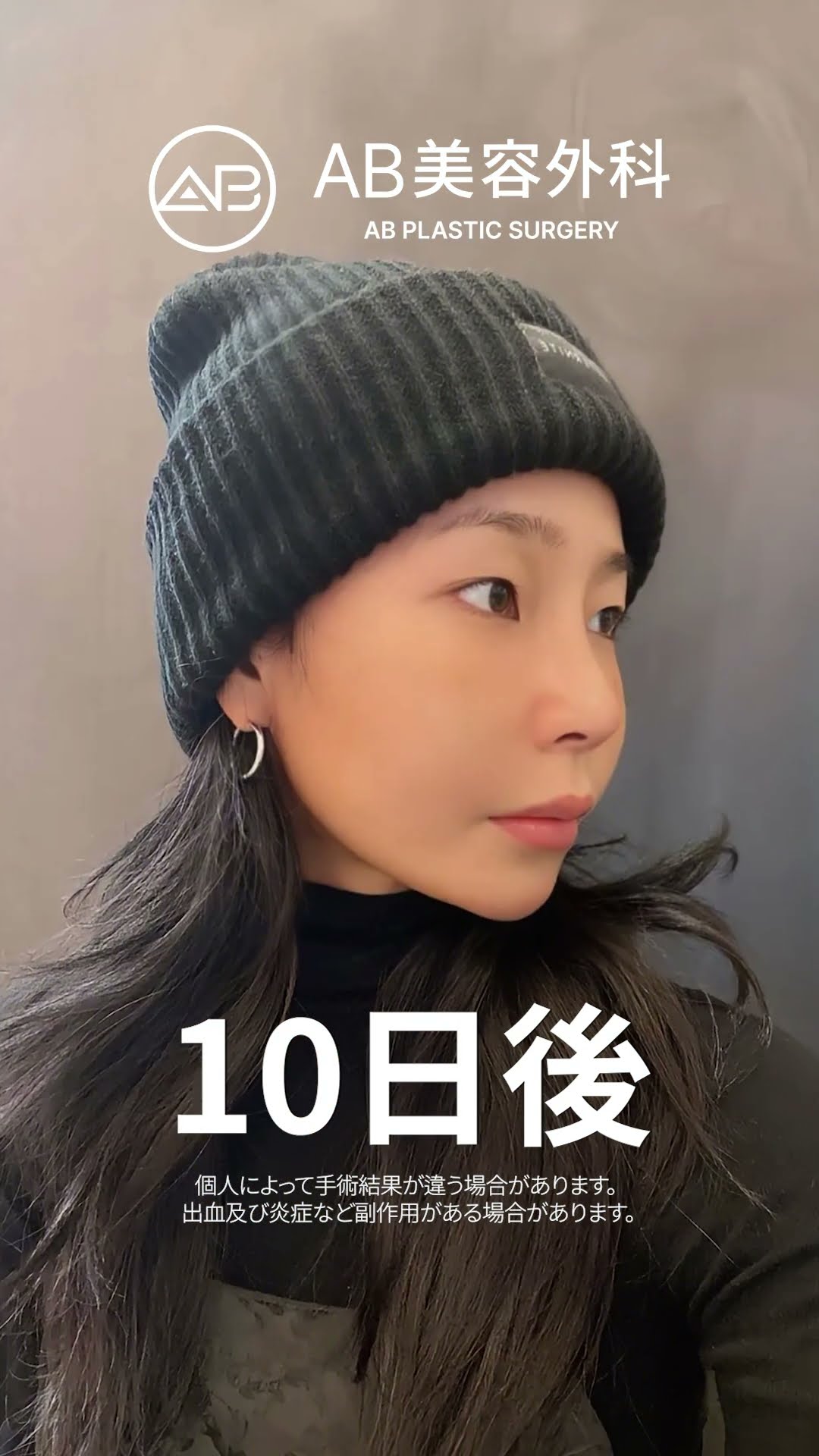 頬骨と鼻の整形で大変身！ベトナム美女の変貌✨ #ビフォーアフター