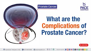 Complications of Prostate Cancer | What are the Complications of Prostate Cancer? | #prostatecancer