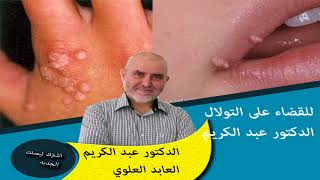 الى كل من يعاني من التولال وصفات طبيعية للقضاء عليه الدكتور عبد الكريم العابد العلوي